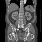 catscan-spine-kidneys-hipbone-thumbnail